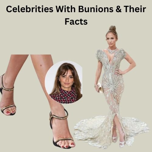 Celebrities With Bunions & Their Facts