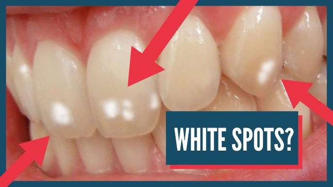Why Do I Have White Spots on My Teeth? Meaning & Fixes 2026