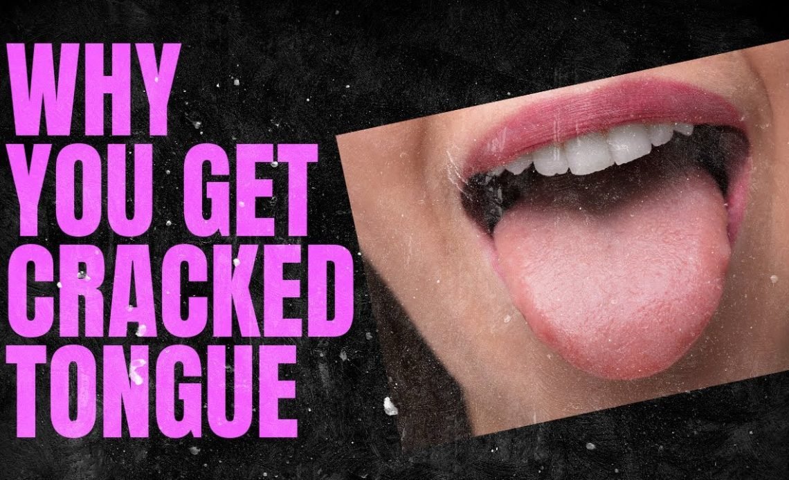 Why Does My Tongue Have Cracks? Meaning & Treatment 2026