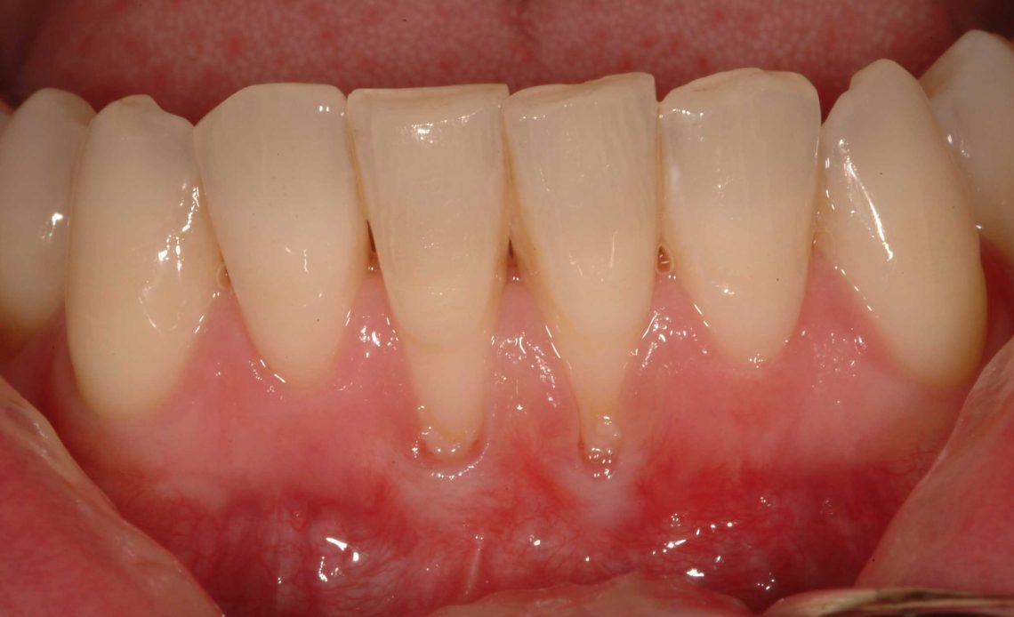 Why Do My Teeth Feel Sensitive? Home Remedies 2026