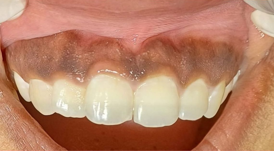 Why Are My Gums Black? Signs You Shouldn't Ignore 2026