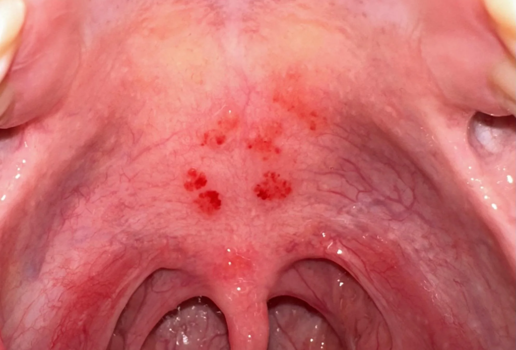 Why Does the Roof of My Mouth Itch After Eating? 2026