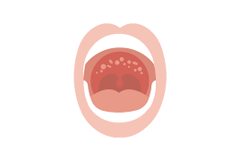 Why Does the Top of My Mouth Hurt When I Eat? (2026 Guide)