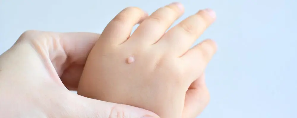 Why Do Kids Get Warts? Is It Contagious? 2026
