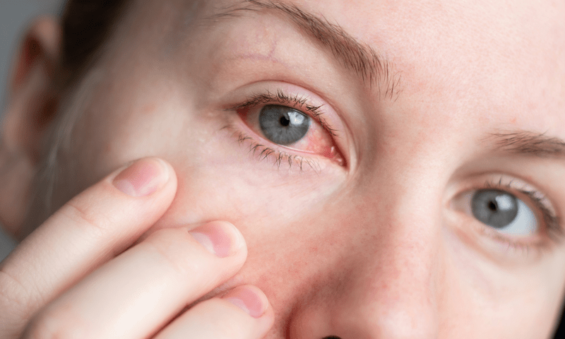 Why Do My Eyes Burn When I Cry? Doctor-Backed Answers 2026