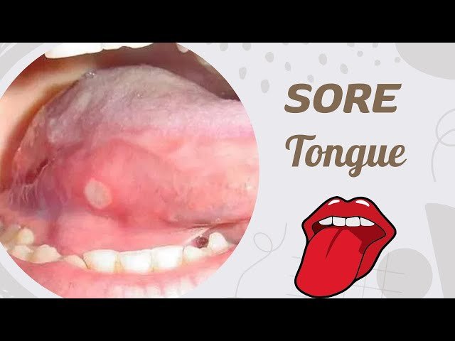 Why Is My Tongue Sore? Causes & Fast Relief 2026