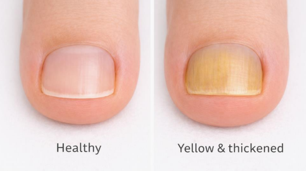 Why Is My Toenail Yellow? Causes & Easy Fixes 2026