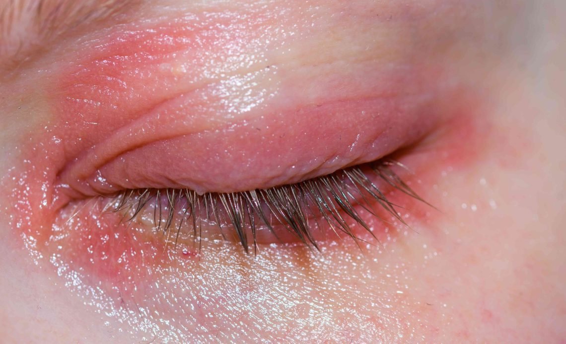 Why Are My Eyelids Red? Top Reasons and Fixes 2026