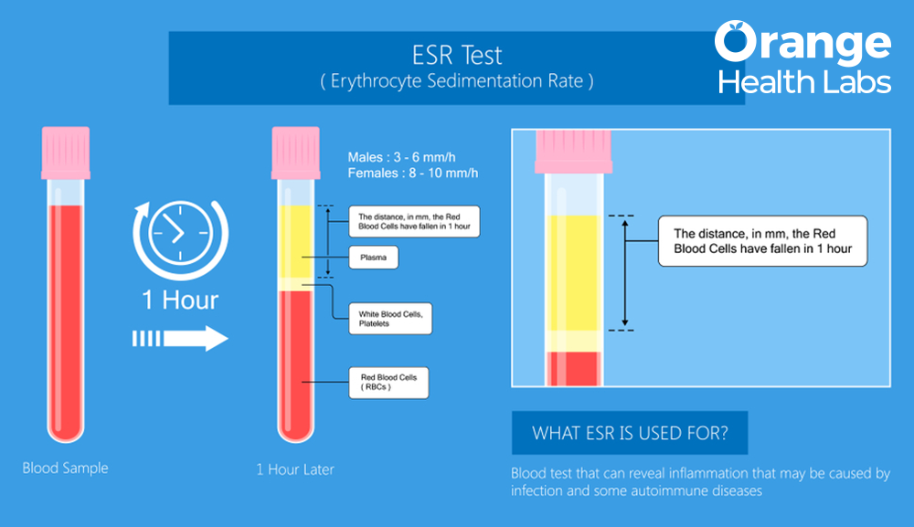 Why ESR Is High in Female? Key Causes Explained 2026
