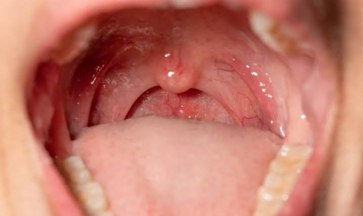 Why Does the Roof of My Mouth Hurt When I Swallow? Reasons 2026