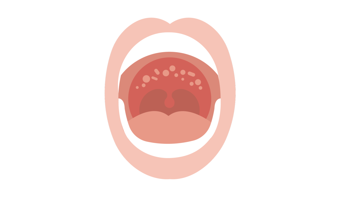Why Does the Roof of My Mouth Hurt? Signs to Know 2026