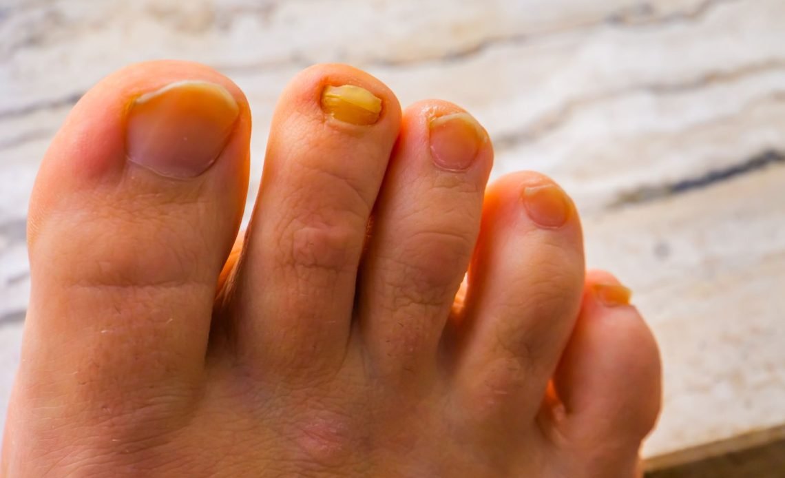 Why Are My Toenails Yellow? Common Causes Revealed 2026