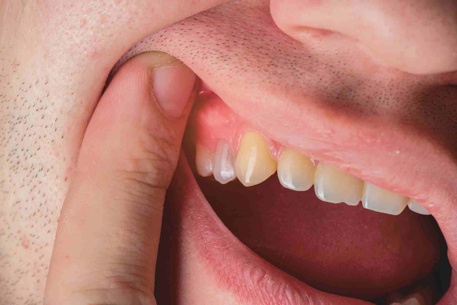 Why Is My Gum Swollen Around One Tooth in the Back? Relief 2026