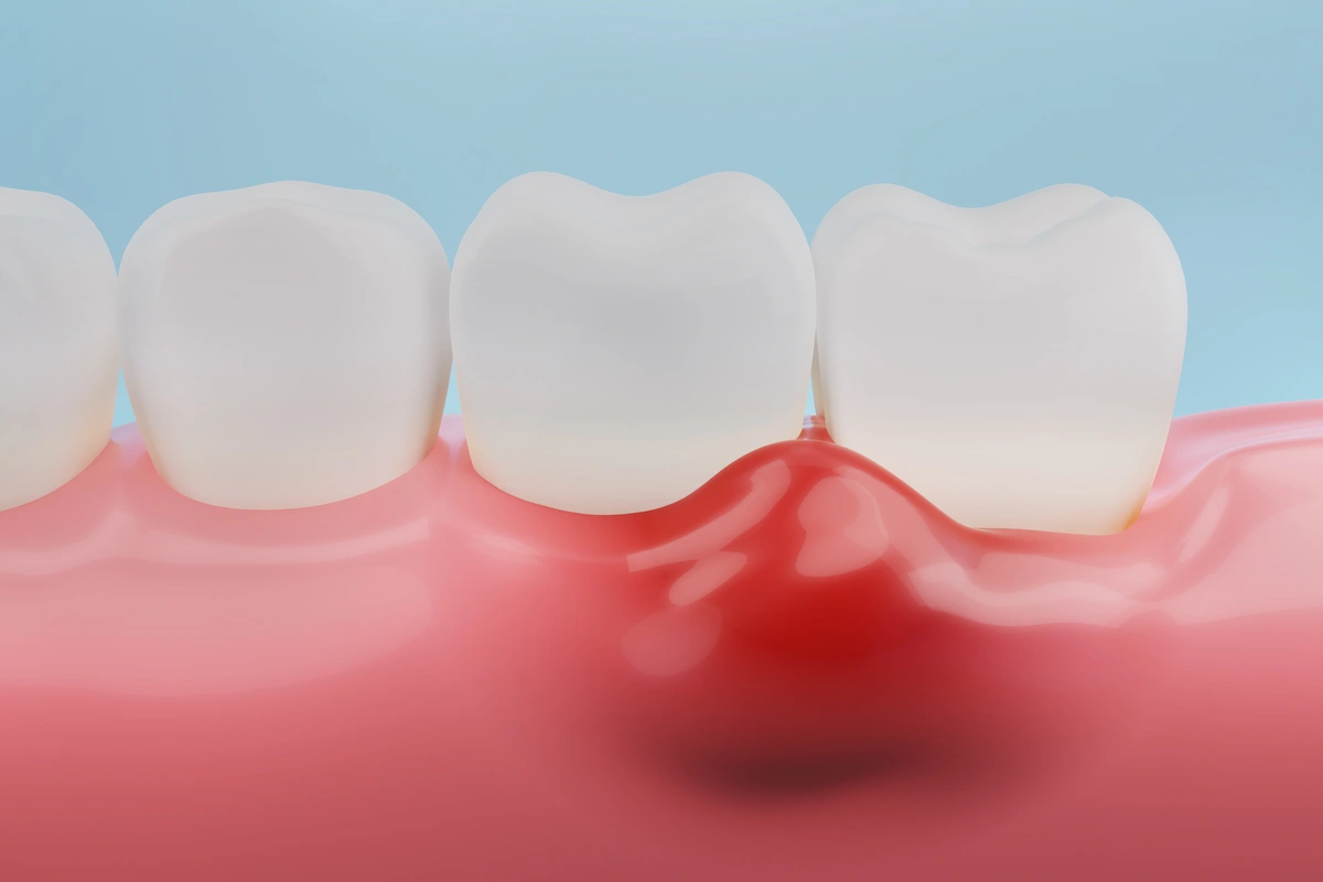 Why Is My Gum Swollen Around One Tooth in the Back? Relief 2026
