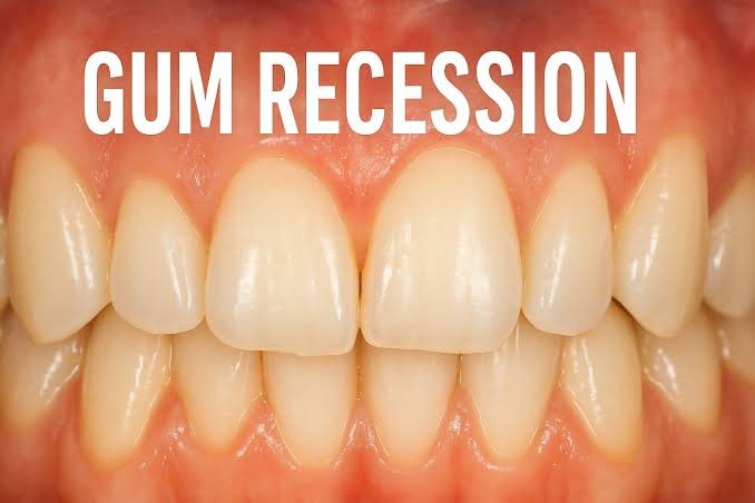 Why Are My Gums Receding? Can They Grow Back? 2026