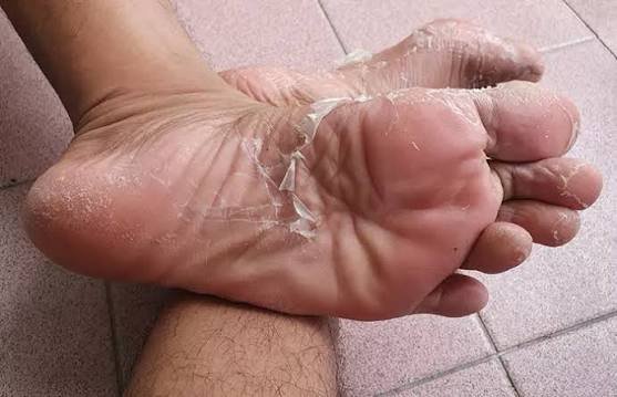 Why Are My Toes Peeling? Fungal & Skin Causes 2026
