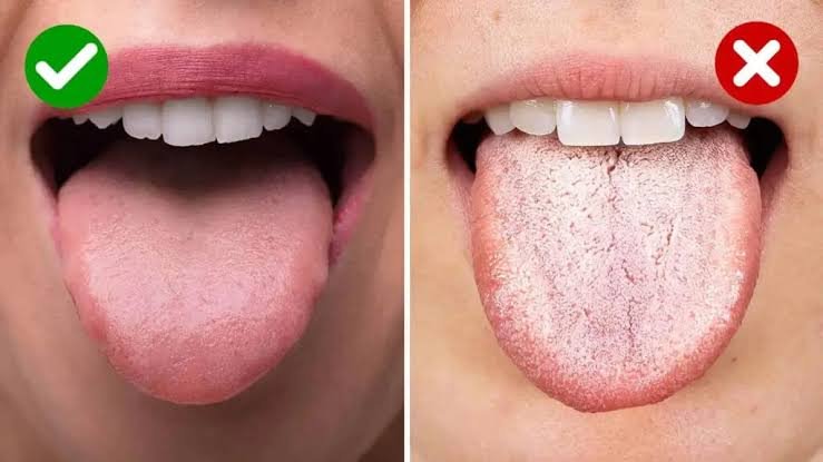 Why My Tongue White? Causes & Treatment 2026