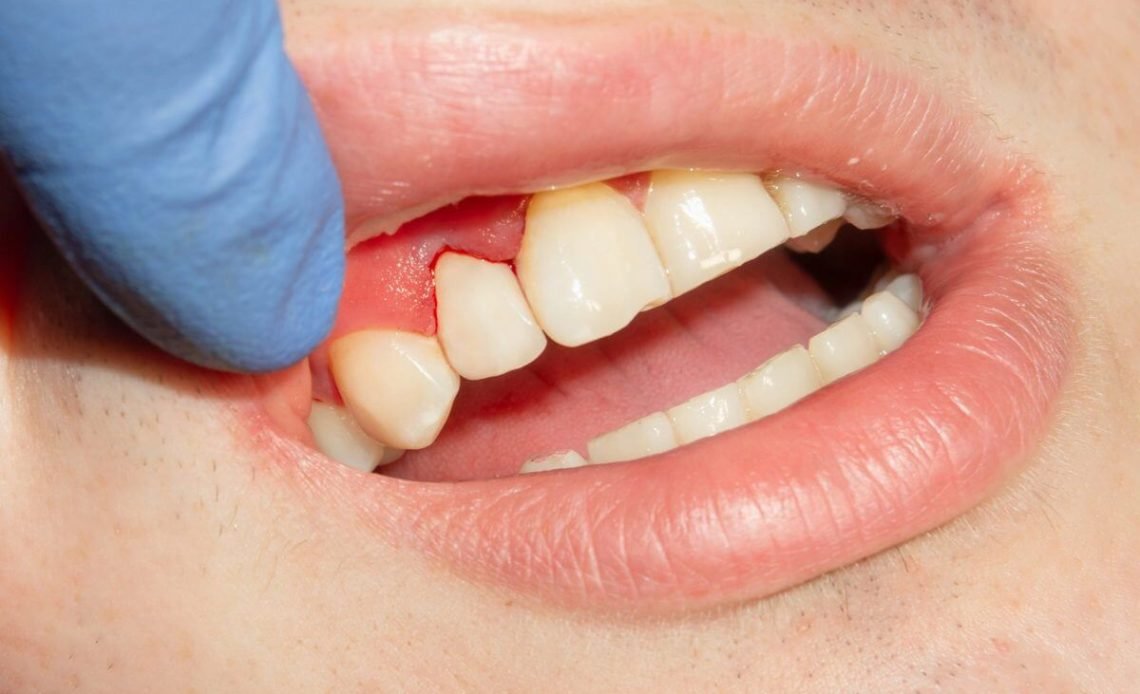 Why Is My Gum Swollen Around One Tooth in the Back? Relief 2026