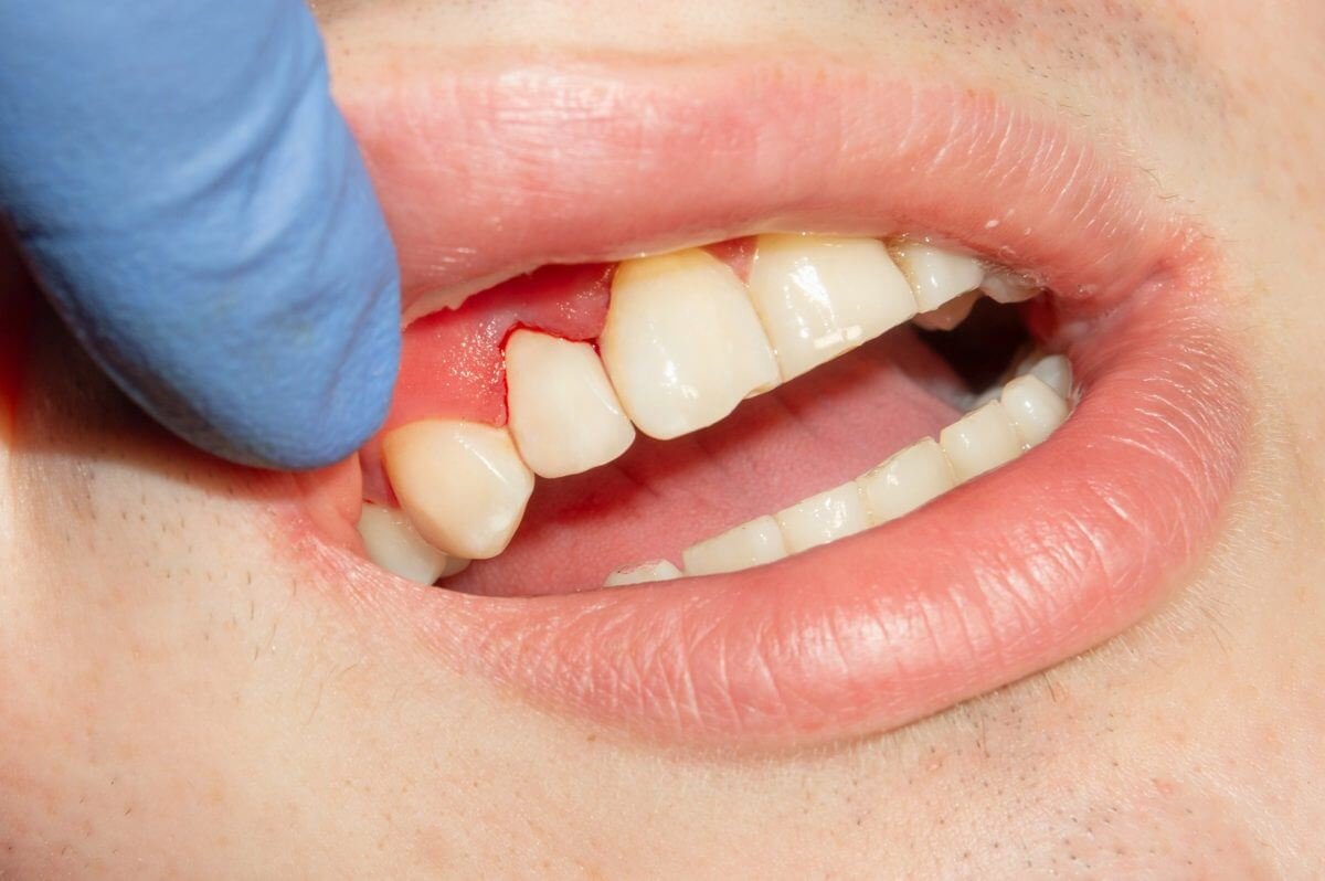 Why Is My Gum Swollen Around One Tooth in the Back? Relief 2026