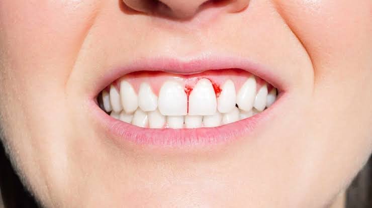 Why Do Gums Bleed? Gum Disease or Something Else? 2026