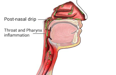 Why Does Post Nasal Drip Cause Sore Throat? Causes & Relief 2026