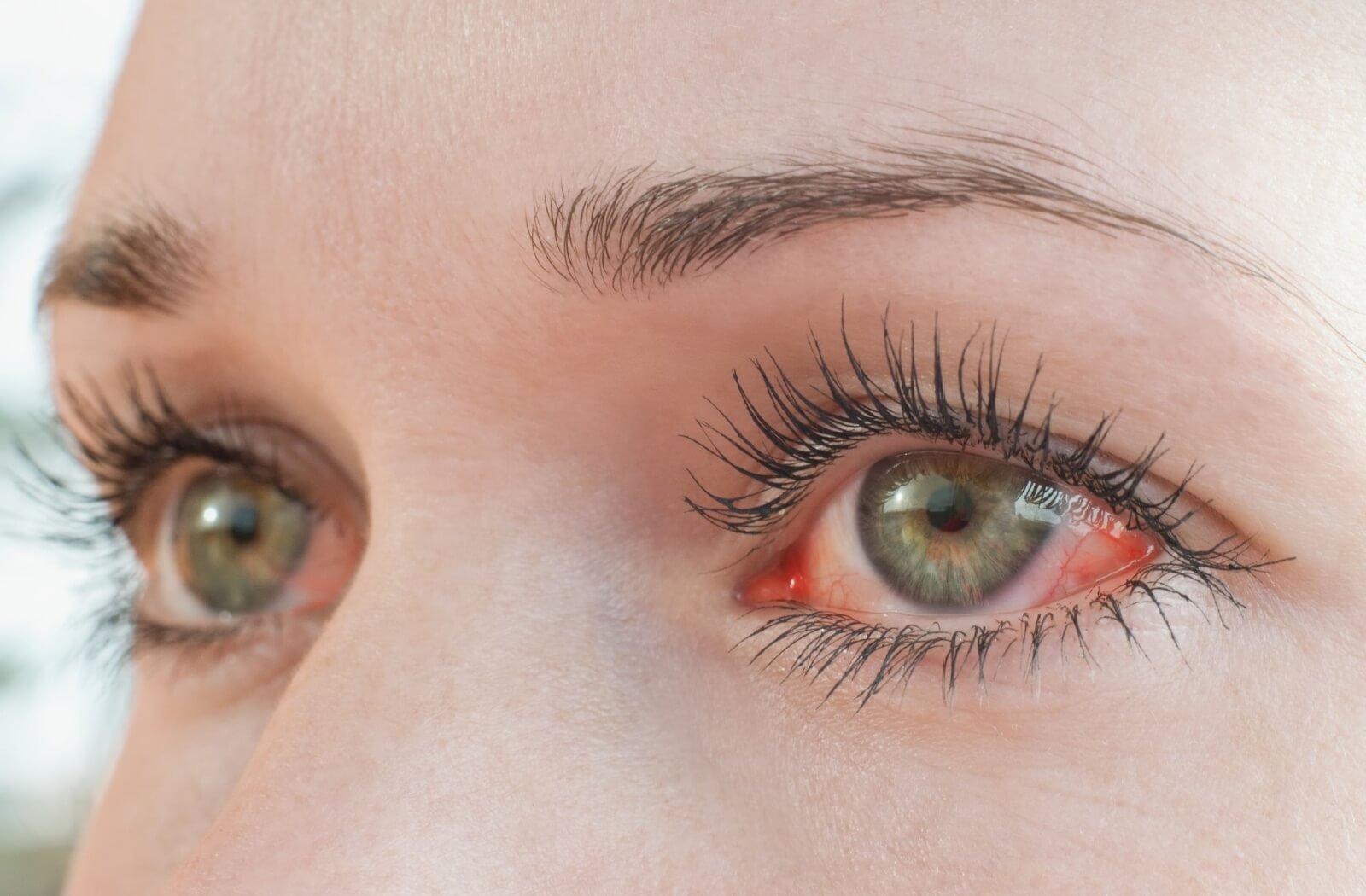 Why Do Eye Drops Burn? Causes, Fixes & Warning Signs 2026