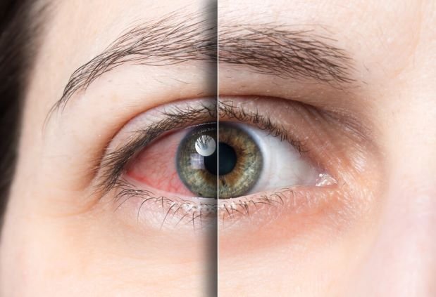 Why Do Eye Drops Burn? Causes, Fixes & Warning Signs 2026