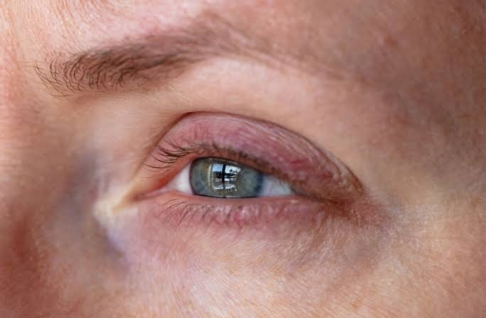Why Do Eye Drops Burn? Causes, Fixes & Warning Signs 2026