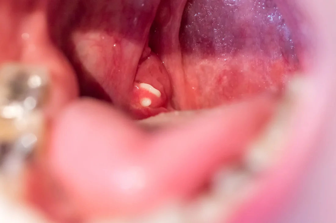 Why Does Post Nasal Drip Cause Sore Throat? Causes & Relief 2026