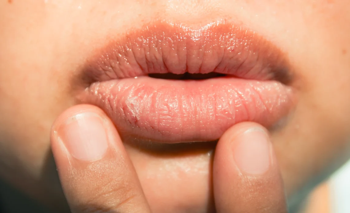 Why Are My Lips Dry? Causes & Fast Relief (2026)