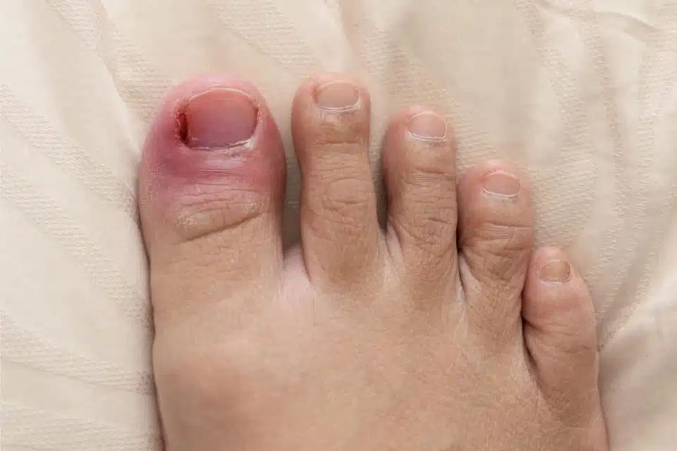 Why Is My Toe Swollen? Causes and When to See a Doctor 2026