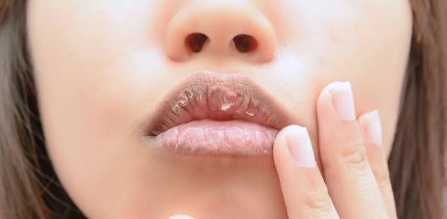 Why Are My Lips Dry? Causes & Fast Relief (2026)