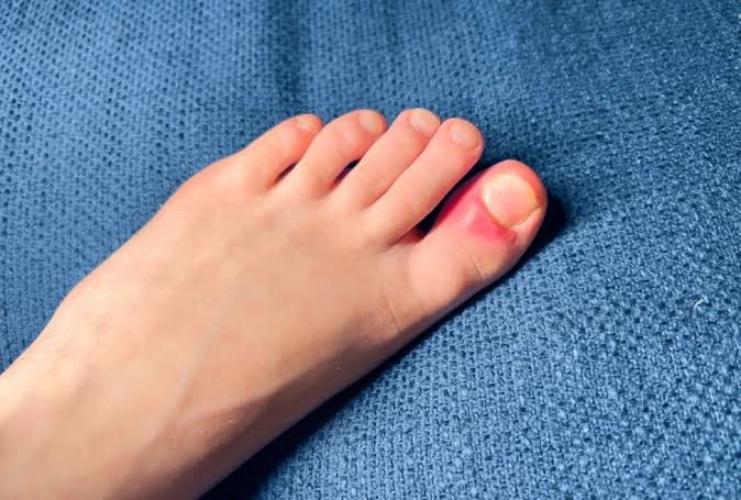 Why Is My Toe Swollen? Causes and When to See a Doctor 2026