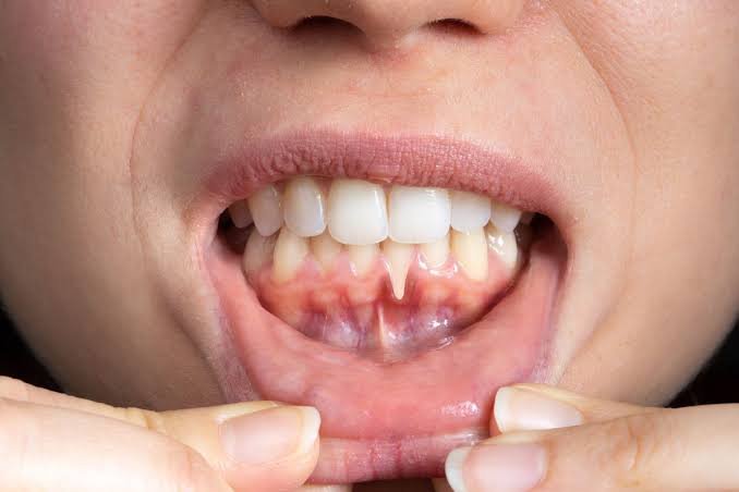 Why Is My Gum Swollen Around One Tooth No Pain? Causes 2026