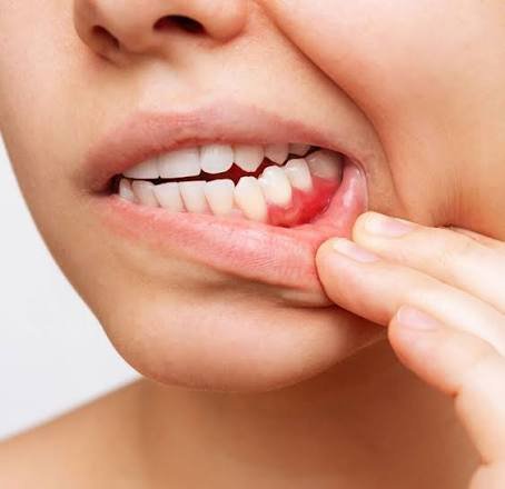 Why Is My Gum Swollen Around One Tooth No Pain? Causes 2026