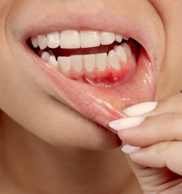 Why Do My Bottom Gums Hurt? Causes & Relief (2026)