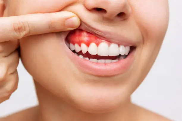 Why Is My Gum Swollen Around One Tooth No Pain? Causes 2026